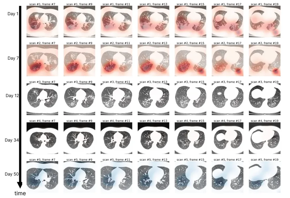Figure 16. Grad-CAM applied to computed tomography images
